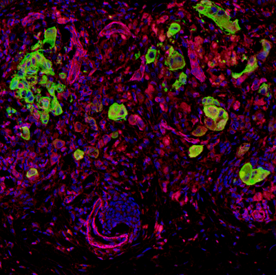 Staining from a human melanoma patient. Melanoma cells are highlighted in green. Individual cells are present in the invasion area, exhibiting an amoeboid/rounded shape near blood vessels.