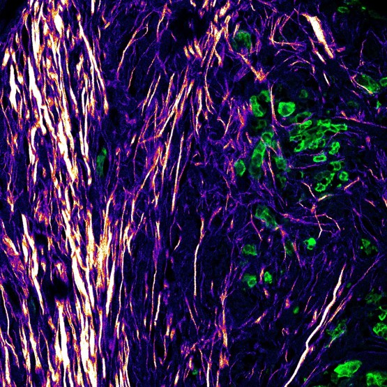 Image of a tissue section from human melanoma captured using a multiphoton microscope. Purple to yellow colours represent extracellular matrix at varying intensities. Malignant melanoma cells in the invasion area are visible in green, exhibiting individual modes. The fibres in this region display a more perpendicular orientation.