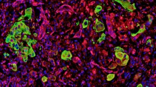 Staining from a human melanoma patient. Melanoma cells are highlighted in green. Individual cells are present in the invasion area, exhibiting an amoeboid/rounded shape near blood vessels.