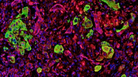 Staining from a human melanoma patient. Melanoma cells are highlighted in green. Individual cells are present in the invasion area, exhibiting an amoeboid/rounded shape near blood vessels.