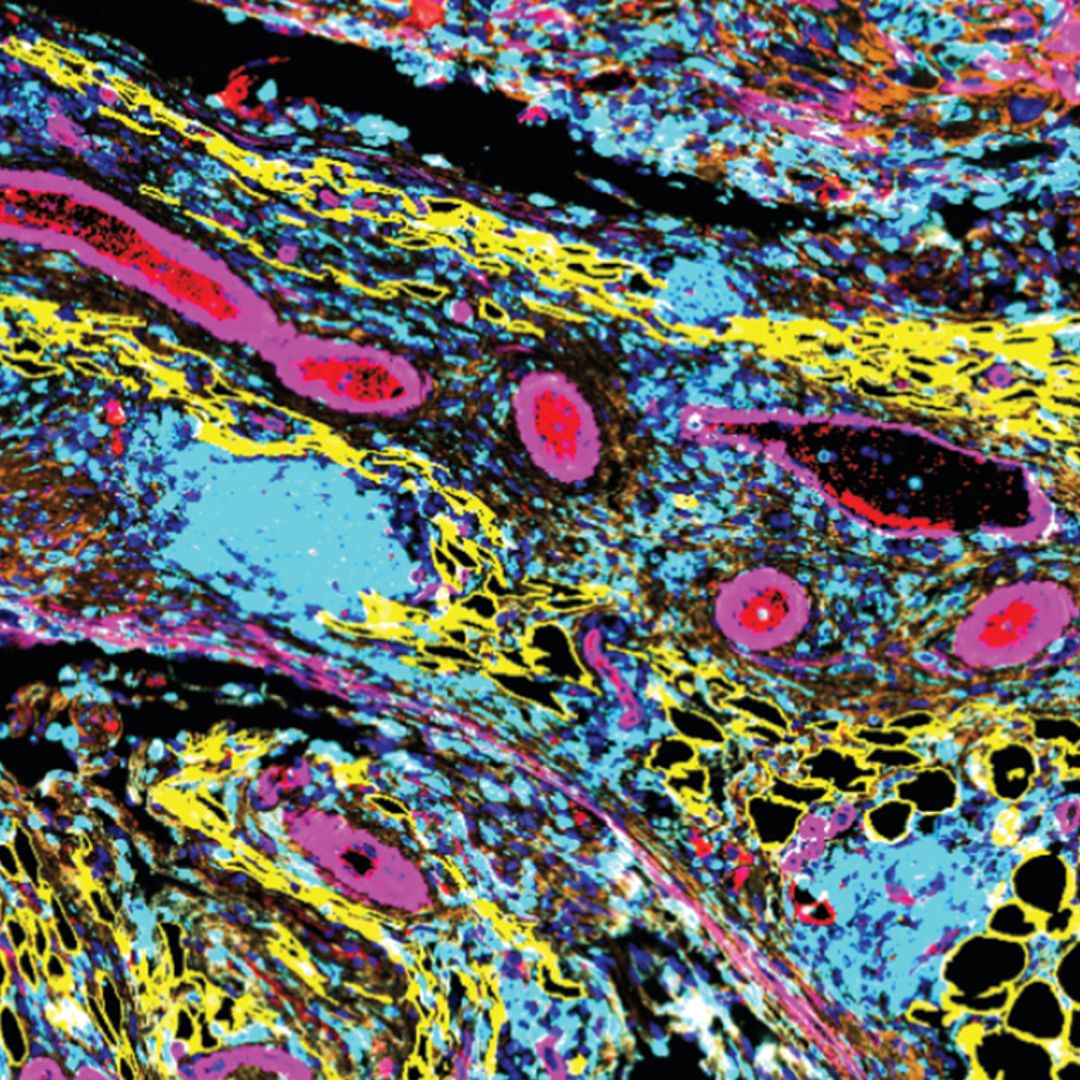 A microscope image of a high-grade serous ovarian cancer tumour in a mouse model, showing extensive immune infiltrate (blue) among omental fat (yellow), cancer cells and stroma (orange) and blood vessels (pink).