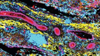 A microscope image of a high-grade serous ovarian cancer tumour in a mouse model, showing extensive immune infiltrate (blue) among omental fat (yellow), cancer cells and stroma (orange) and blood vessels (pink).