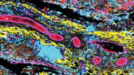 A microscope image of a high-grade serous ovarian cancer tumour in a mouse model, showing extensive immune infiltrate (blue) among omental fat (yellow), cancer cells and stroma (orange) and blood vessels (pink).