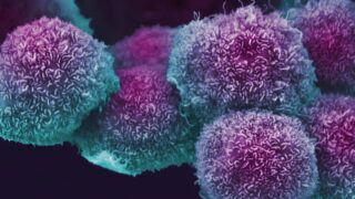 Pancreatic cancer cells grown in culture, SEM. Anne Weston, Francis Crick Institute. Source: Wellcome Collection.