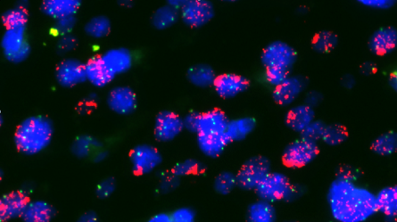 Patient glioblastoma cells (with nucleus in blue) harbouring ecDNA-amplified EGFR (red).