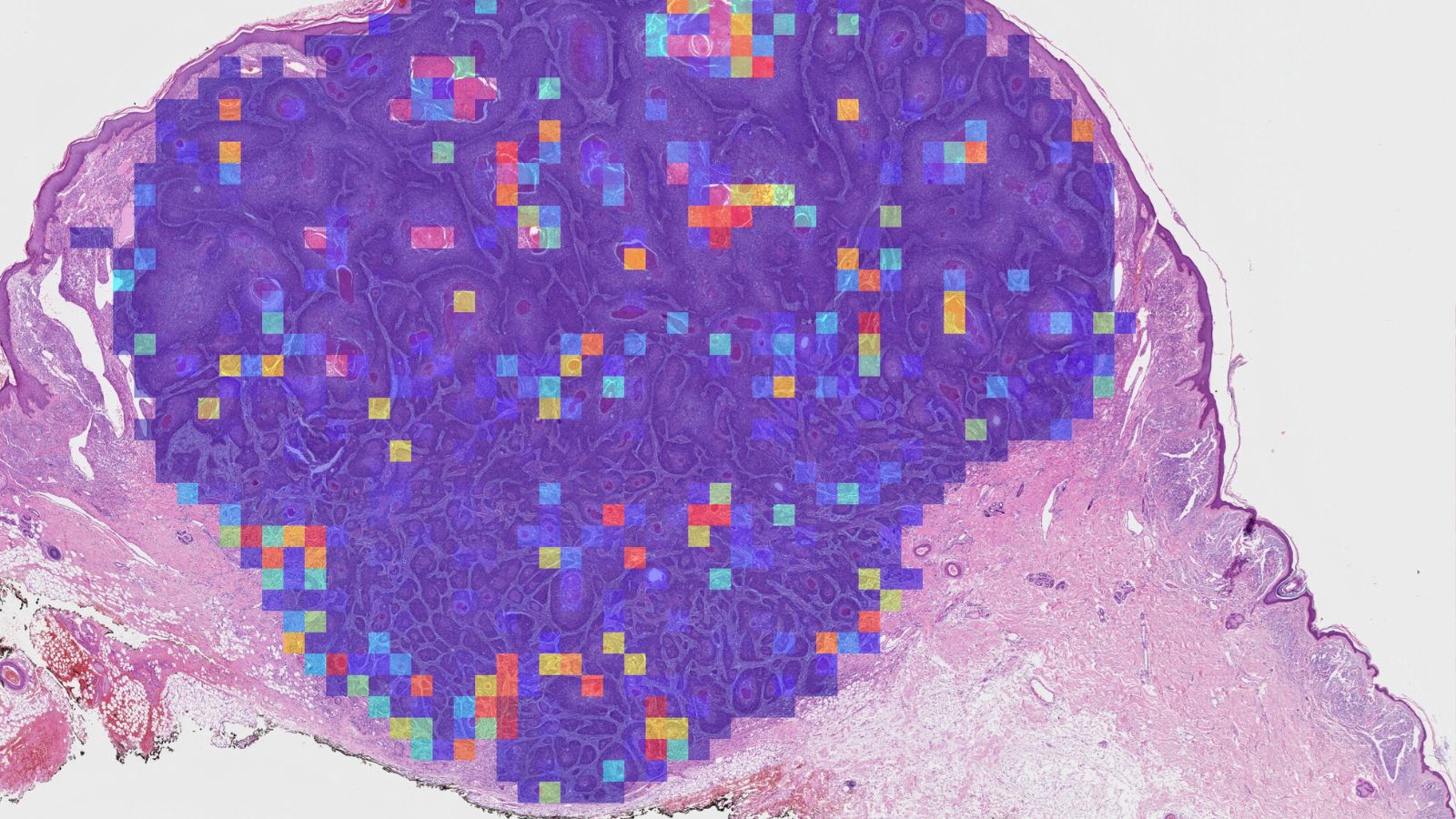 cSCC tissue sample with AI-generated heatmap of tumour risk score